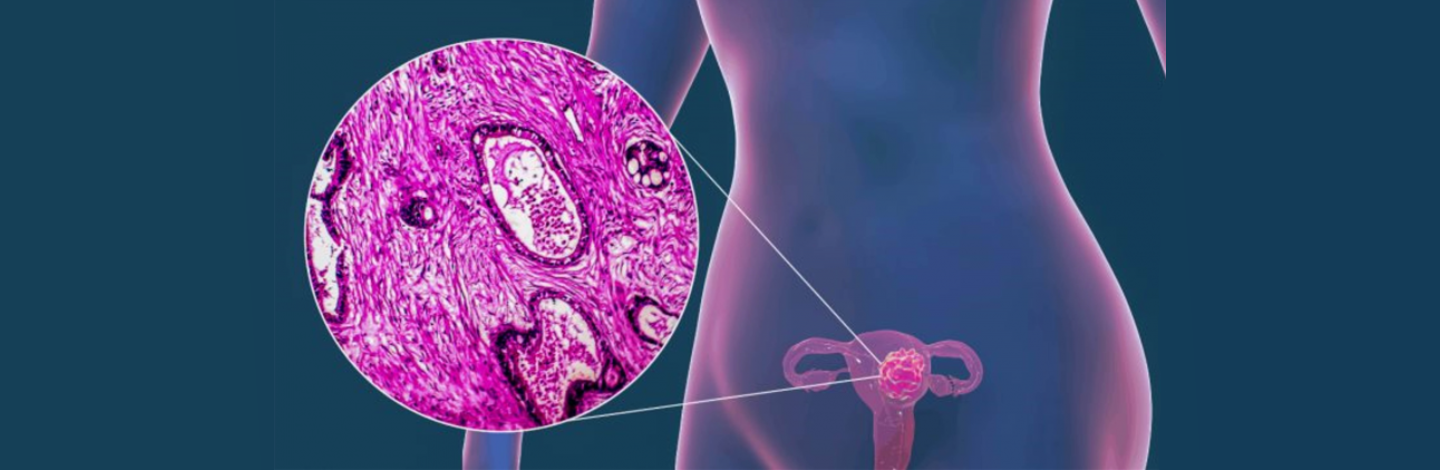 Caso clínico: Tratamiento de verrugas vaginales con Papilocare®. 