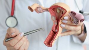 P4, cáncer de endometrio