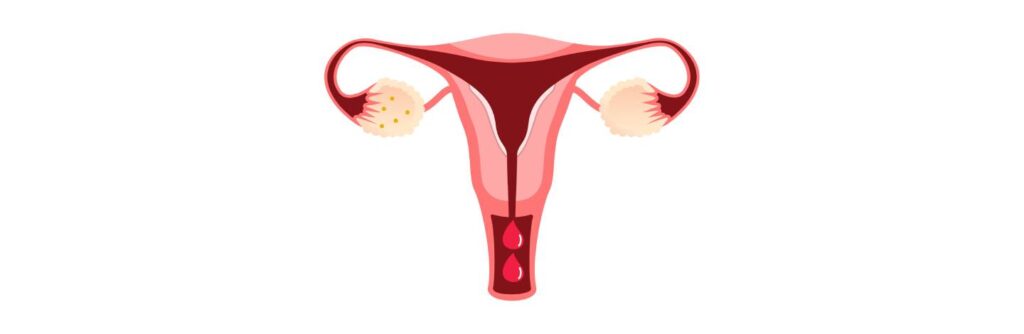 P4 y sangrado uterino anormal