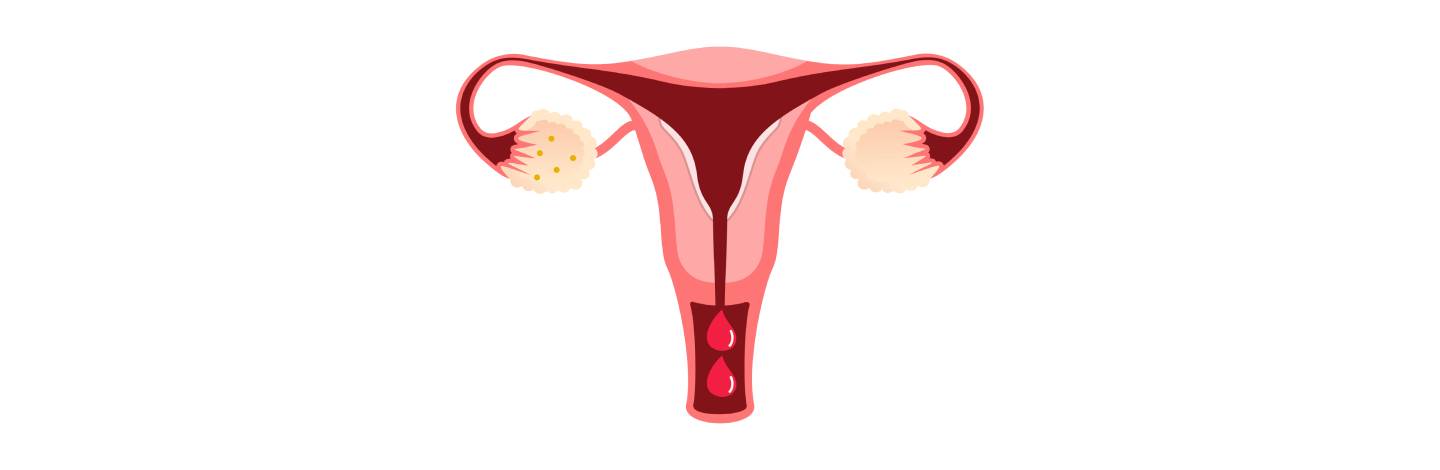 P4 y sangrado uterino anormal