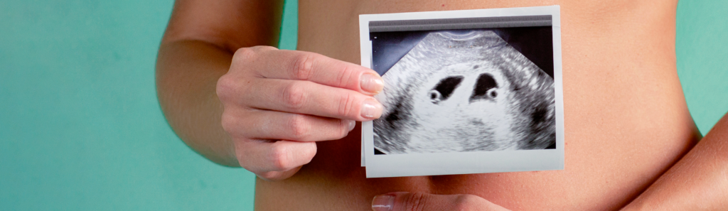 El consenso Delphi internacional, publicado en 2025, cuyo objetivo fue estandarizar el diagnóstico prenatal y el manejo del parto pretérmino (PTB) en embarazos gemelares.